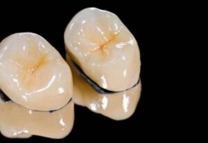 Dental Implants Tustin